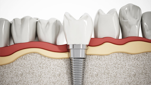 Yu Smile Dental | Extractions, Emergency Treatment and Root Canals
